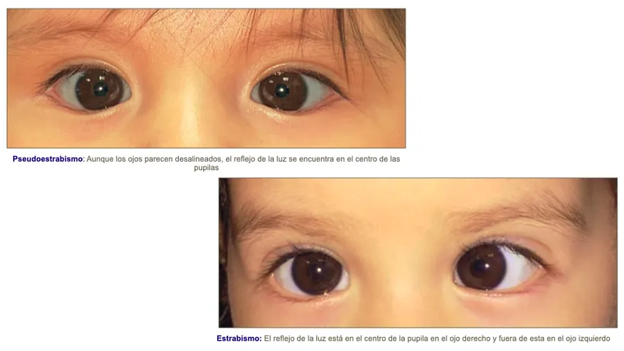 Estrabismo: ojos no alineados