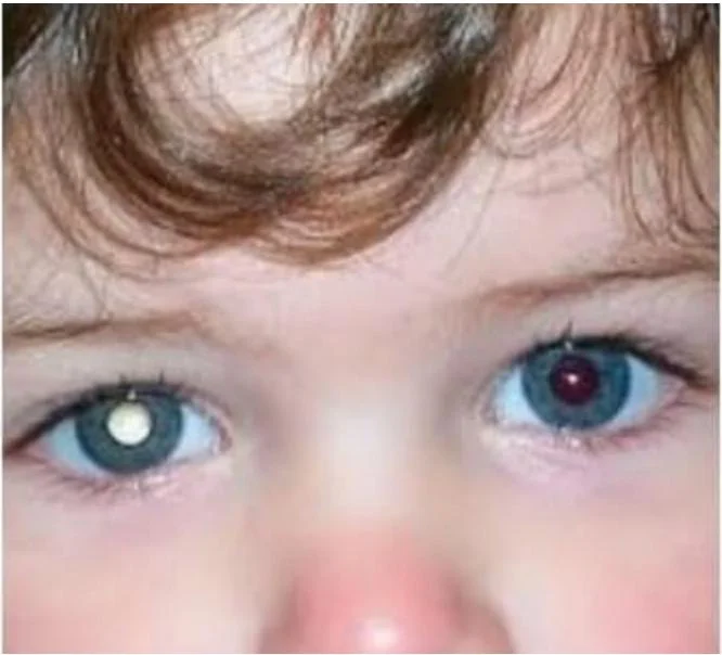 Leucocoria en niño — señal de catarata pediátrica